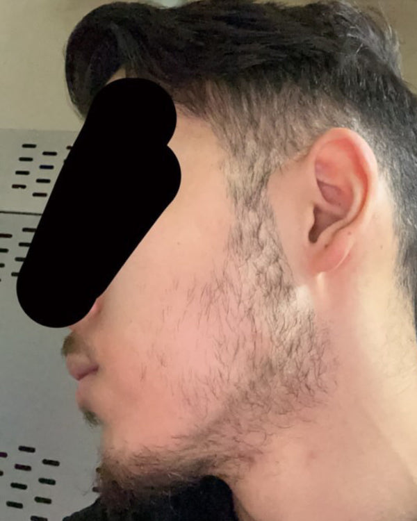Before photo – Bilal M.