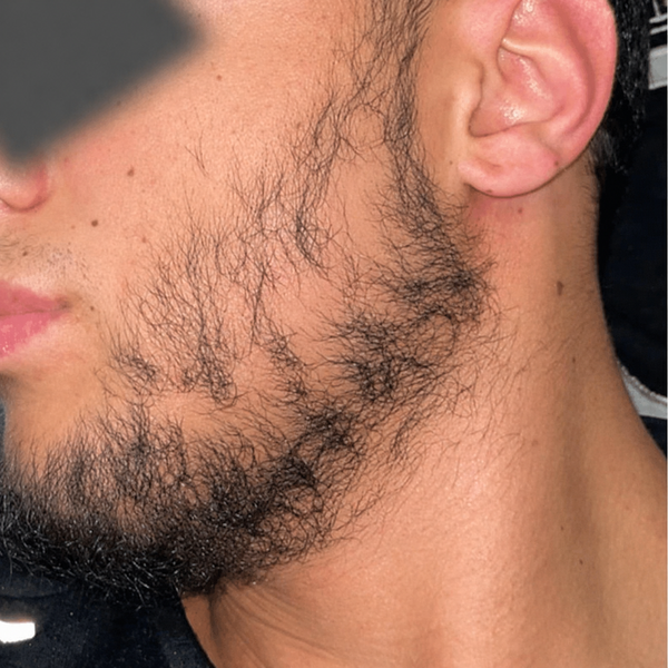 Before photo – Ronit D.
