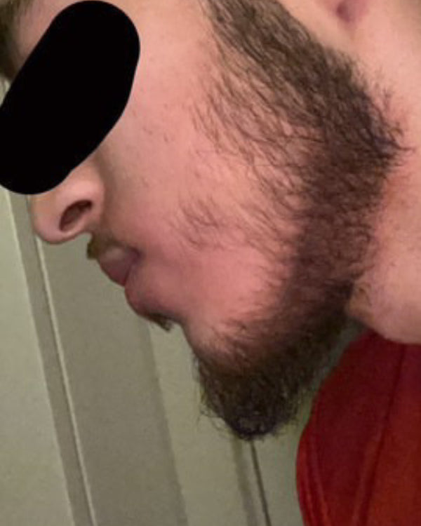 After photo – Bilal M.